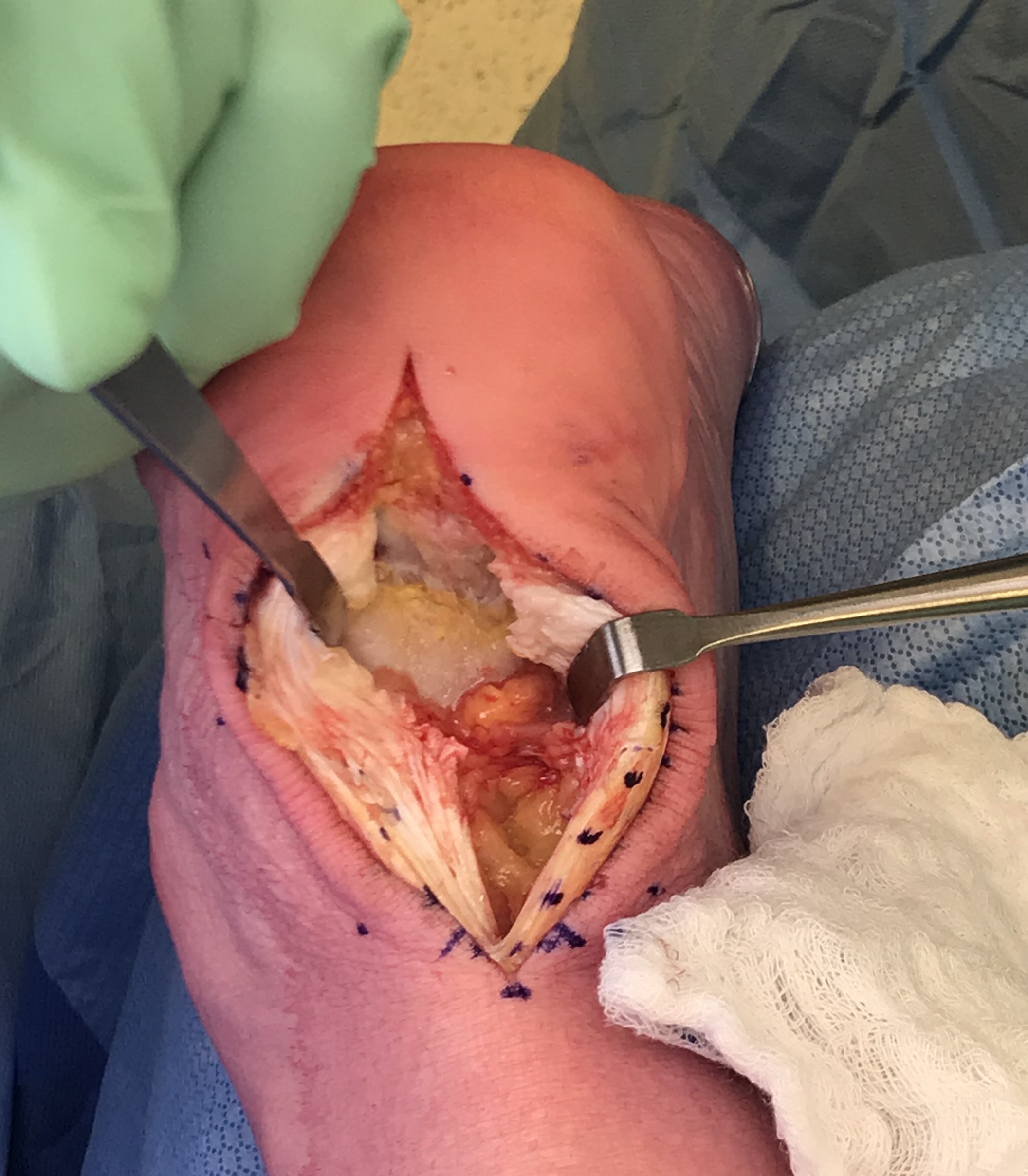 Insertional Achilles Tendonitis Surgery