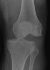 Knee dislocation lateral