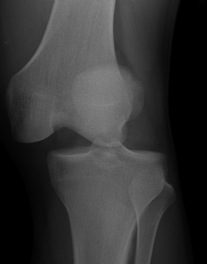 Knee dislocation medial