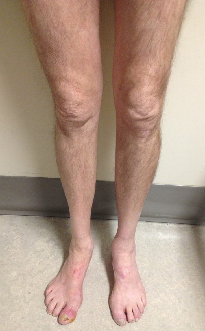 CMT Stork Legs