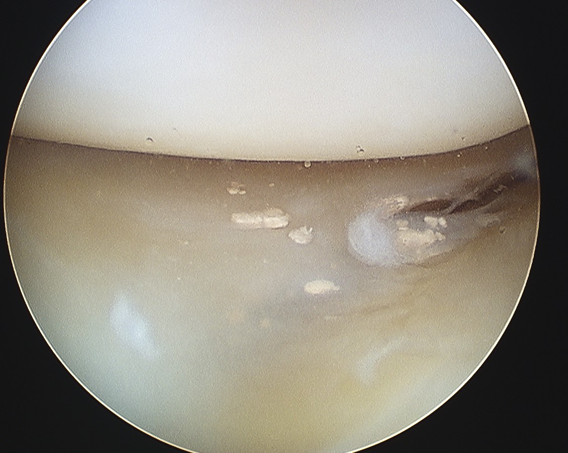 Chondrocalcinosis Knee Arthroscopy