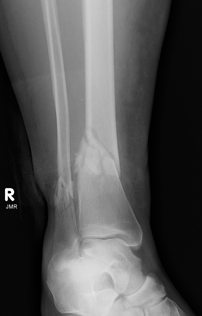 Distal Tibial Fracture