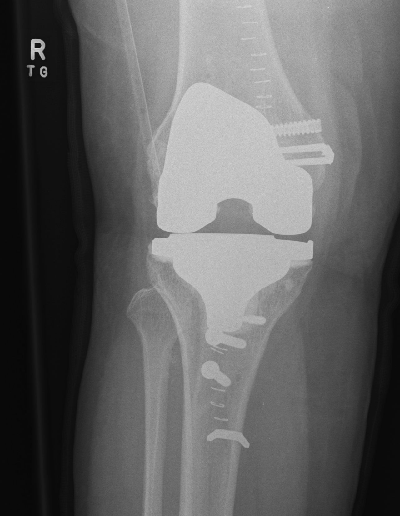 Patella 