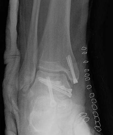 Talar Body Fracture 