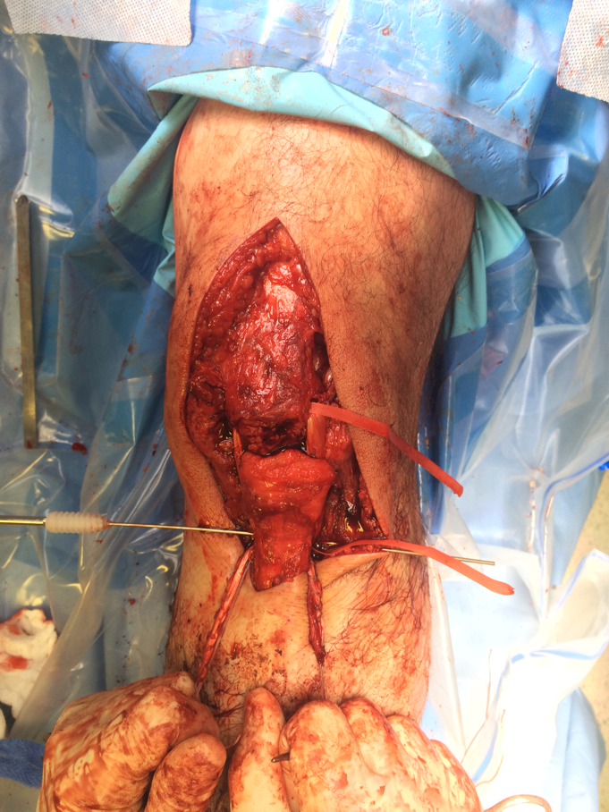 Chronic patella tendon rupture Hamstring Recon
