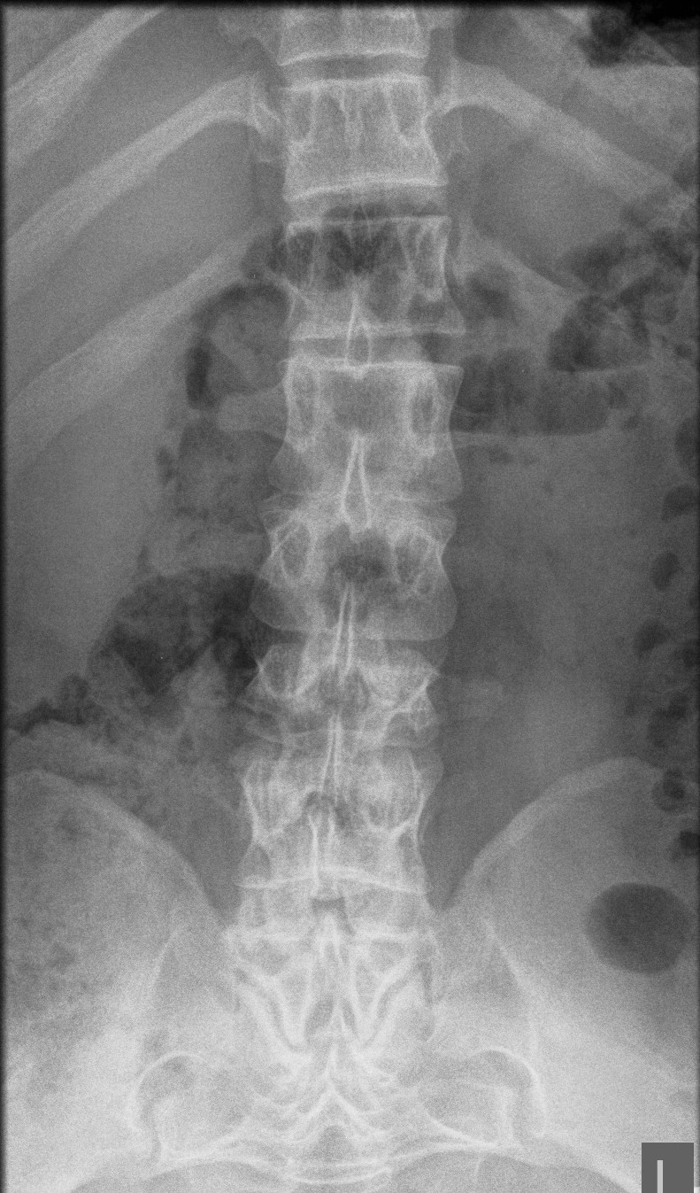 achondroplasia x ray vs normal
