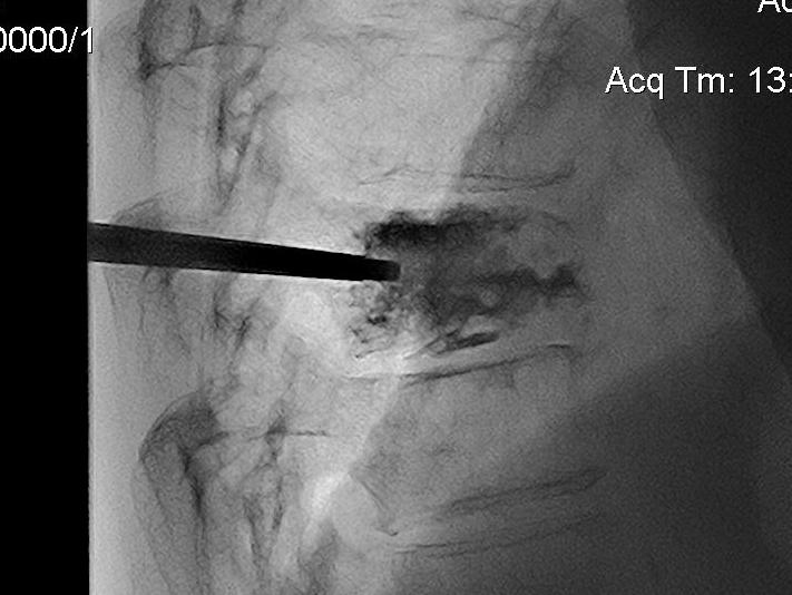 Kyphoplasty Lateral