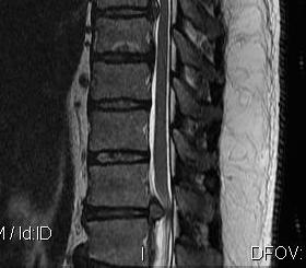 herniated disc thoracic mri