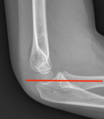 Supracondylar Fracture 