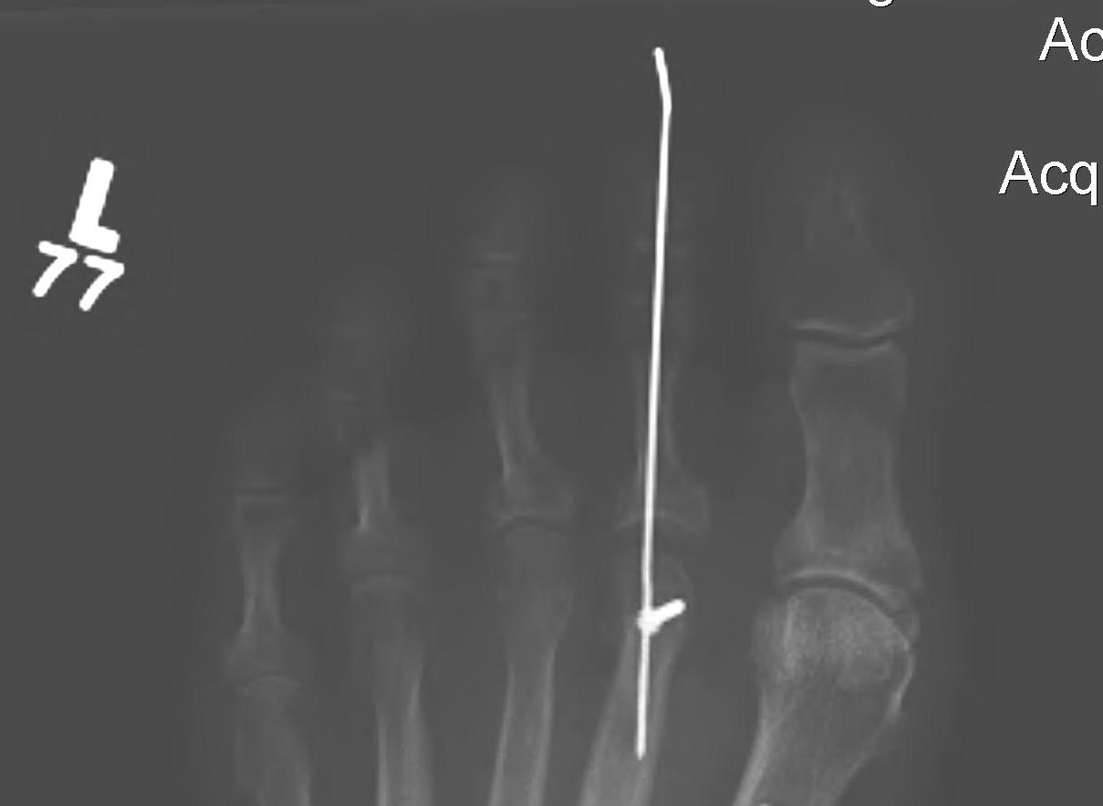 hammer toe xray