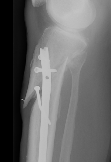 Minimally invasive distal tibial osteotomy and correction of deformity with  the Taylor Spatial Frame – Orthoracle LuanMD