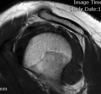 acromion types mri