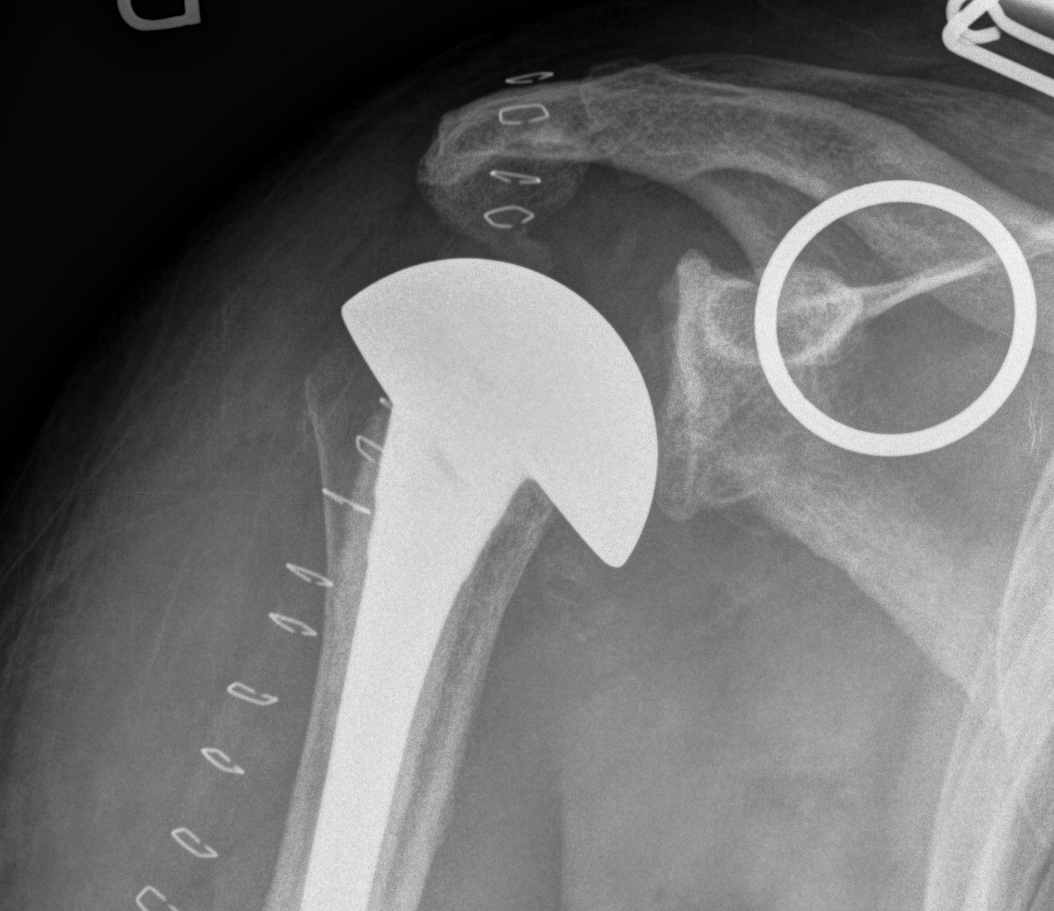 Rotator Cuff Tear Arthropathy St Albans