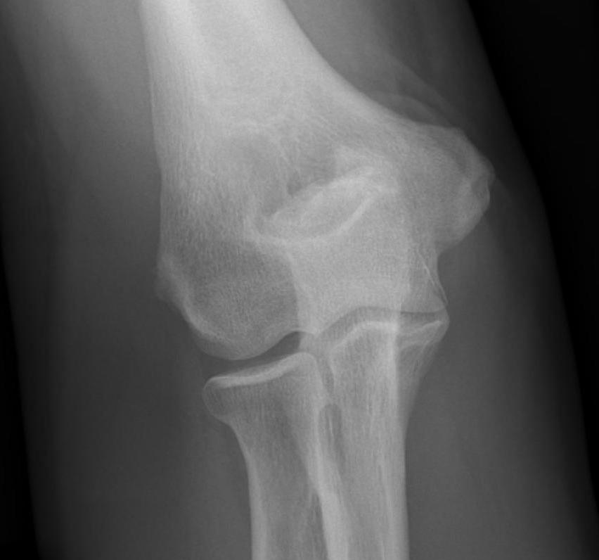 Osteoarthritis & Stiffness 