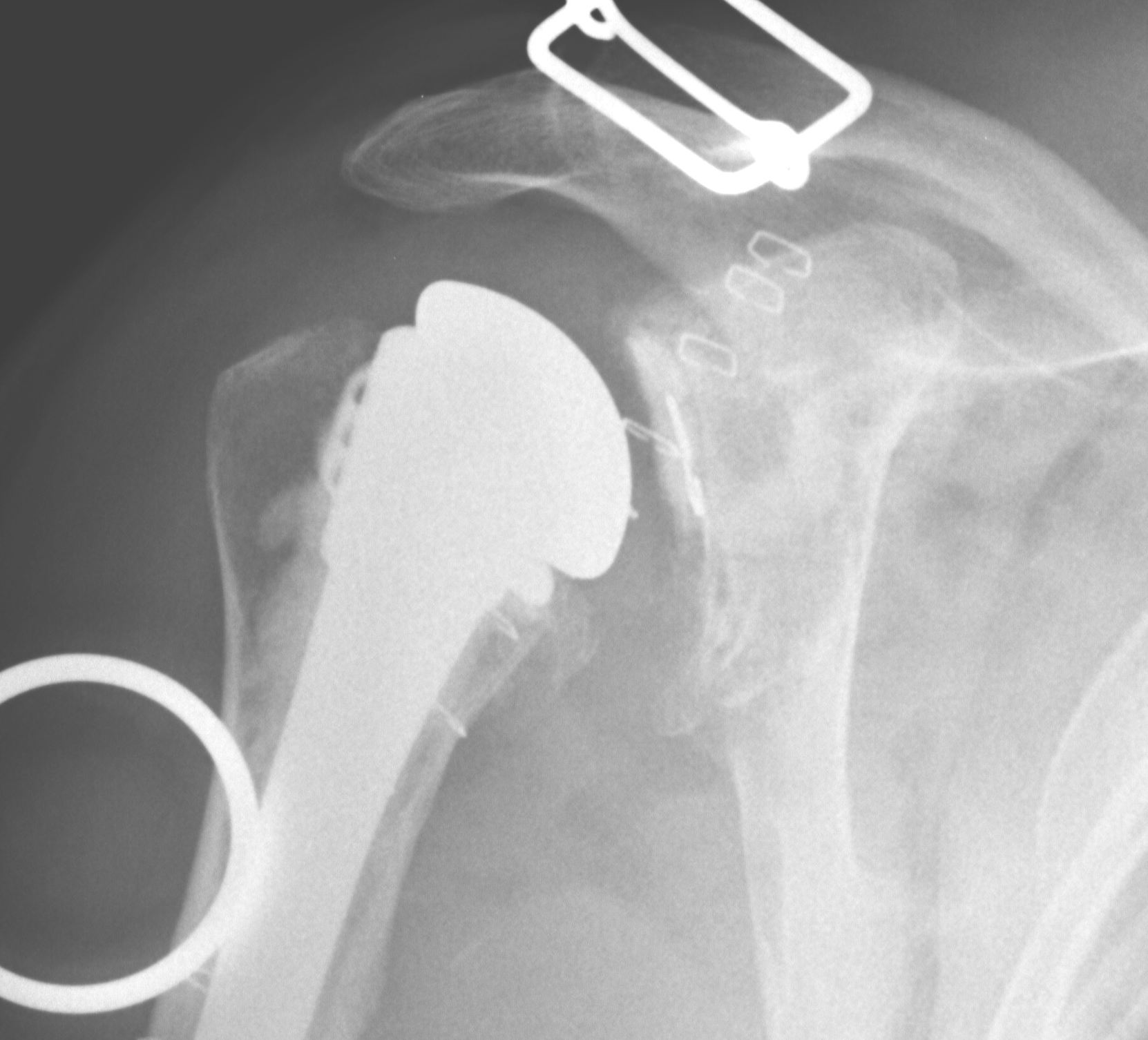 Revision Shoulder Arthroplasty 