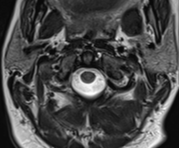 Atlanto axial MRI