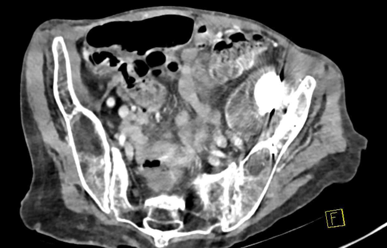 Intra-pelvic revision