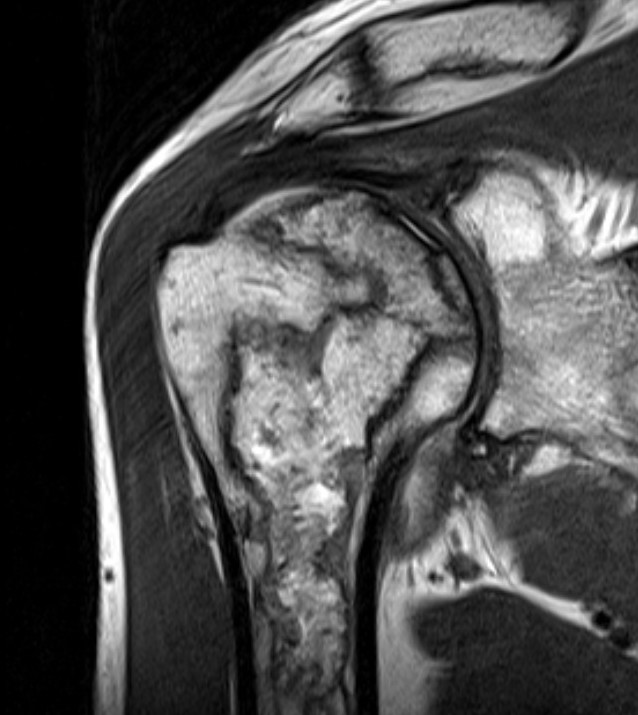 Shoulder AVN MRI