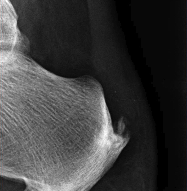 Achilles calcification