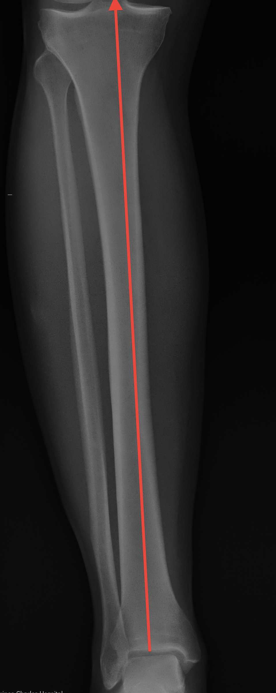 Tibial anatomic axis