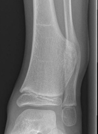 Osteochondroma ankle