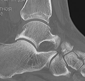 Ankle CT