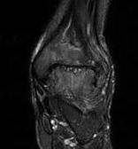 ANkle MRI