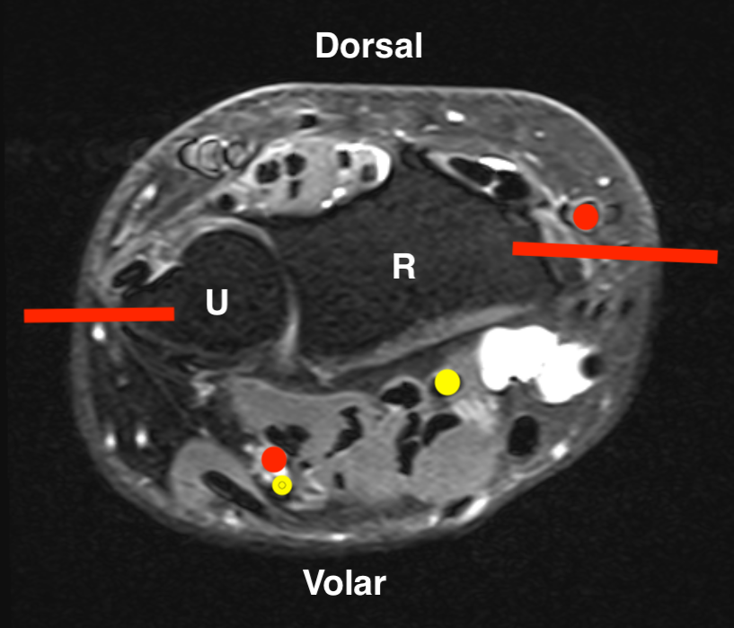 Distal radius biopsy