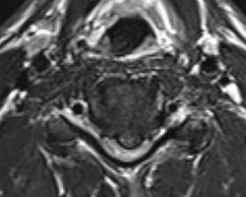MRI cervical disc