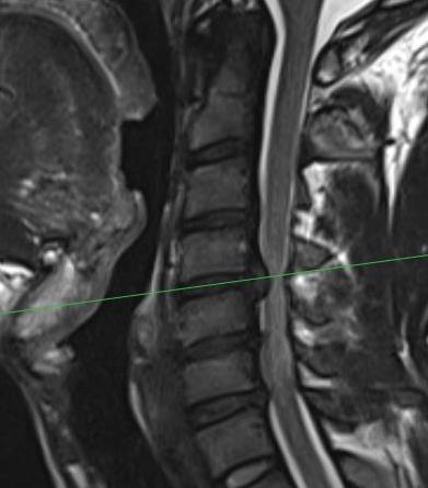 C disc MRI sagittal