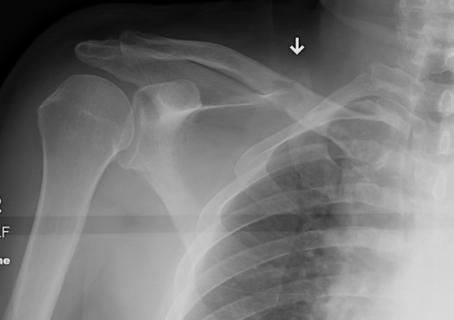 Clavicle pathological fracture