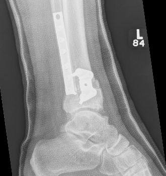 Supramall osteotomy