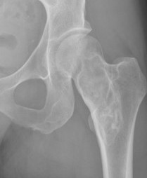 Fibrous dysplasia hip