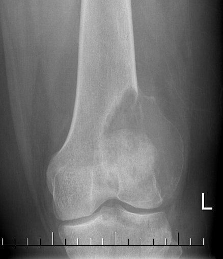 GCT knee 1