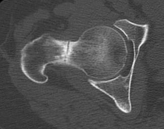 Hip stress fracture CT