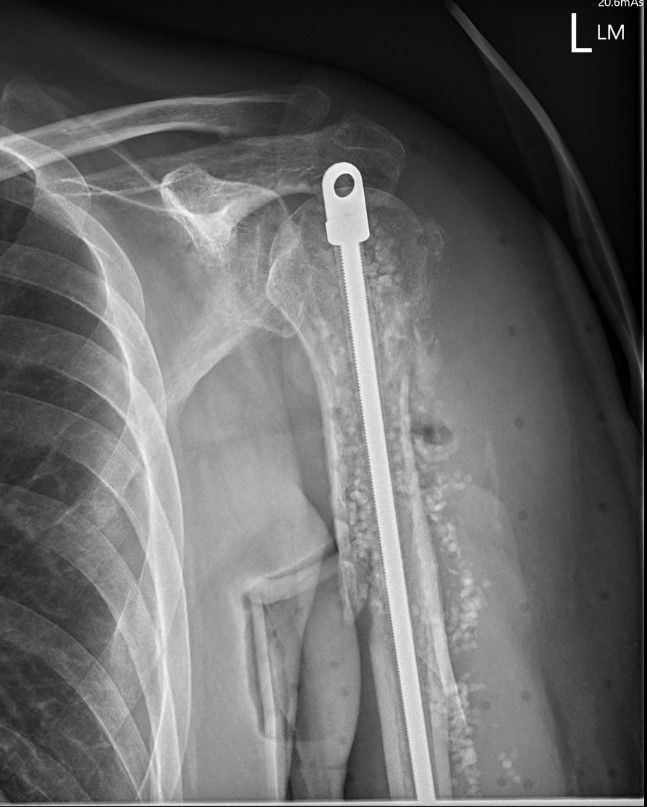 Humerus infection 1