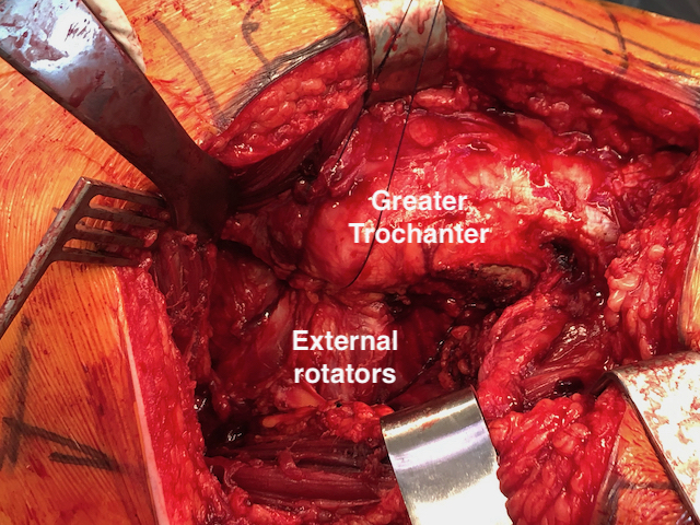 Posterior approach