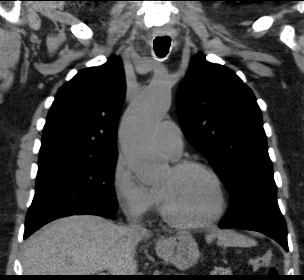 Lung metastasis CT chest
