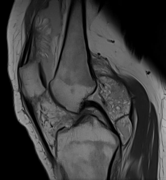 Arborsescens MRI