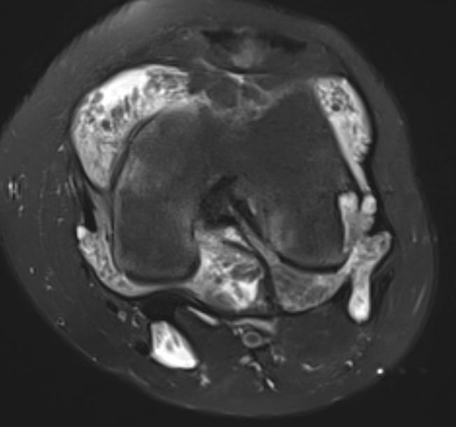 arborescens mri 