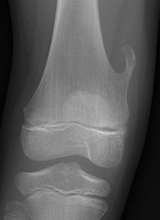 Osteochondroma knee