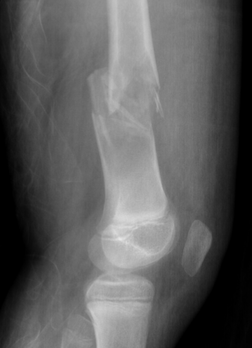 Distal femur UBC fracture 2