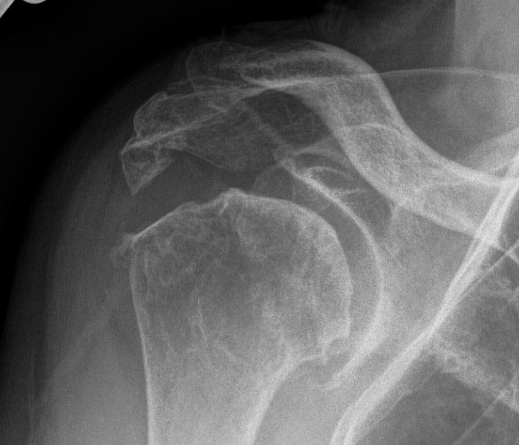 rheumatoid arthritis shoulder
