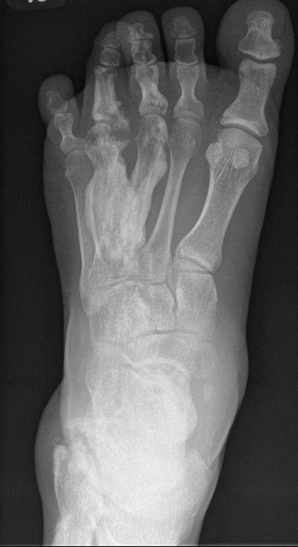 Meleorheotosis foot 2