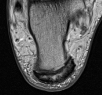 Insertional