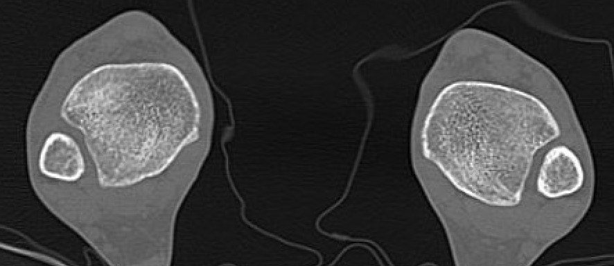 Bilateral CT