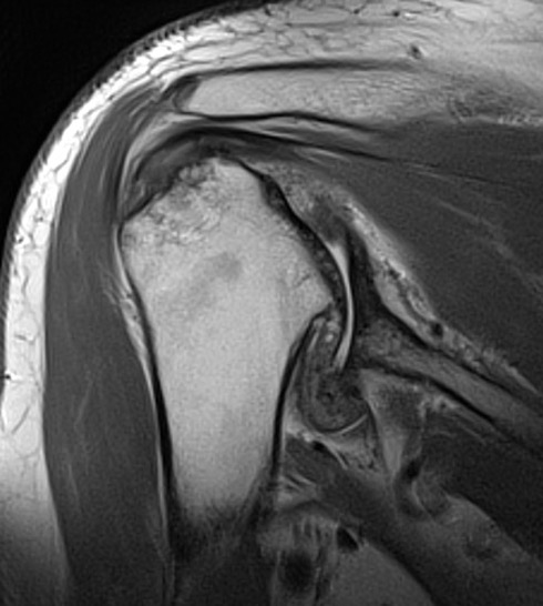 Shoulder OA intact cuff on MRI