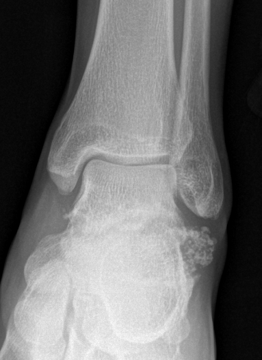Syn oc ankle xray 2