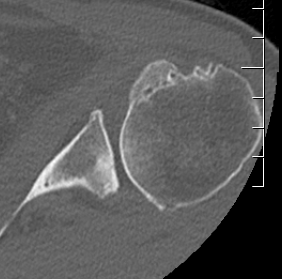 Glenoid retroversion and posterior wear