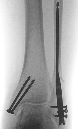 Fibular nail